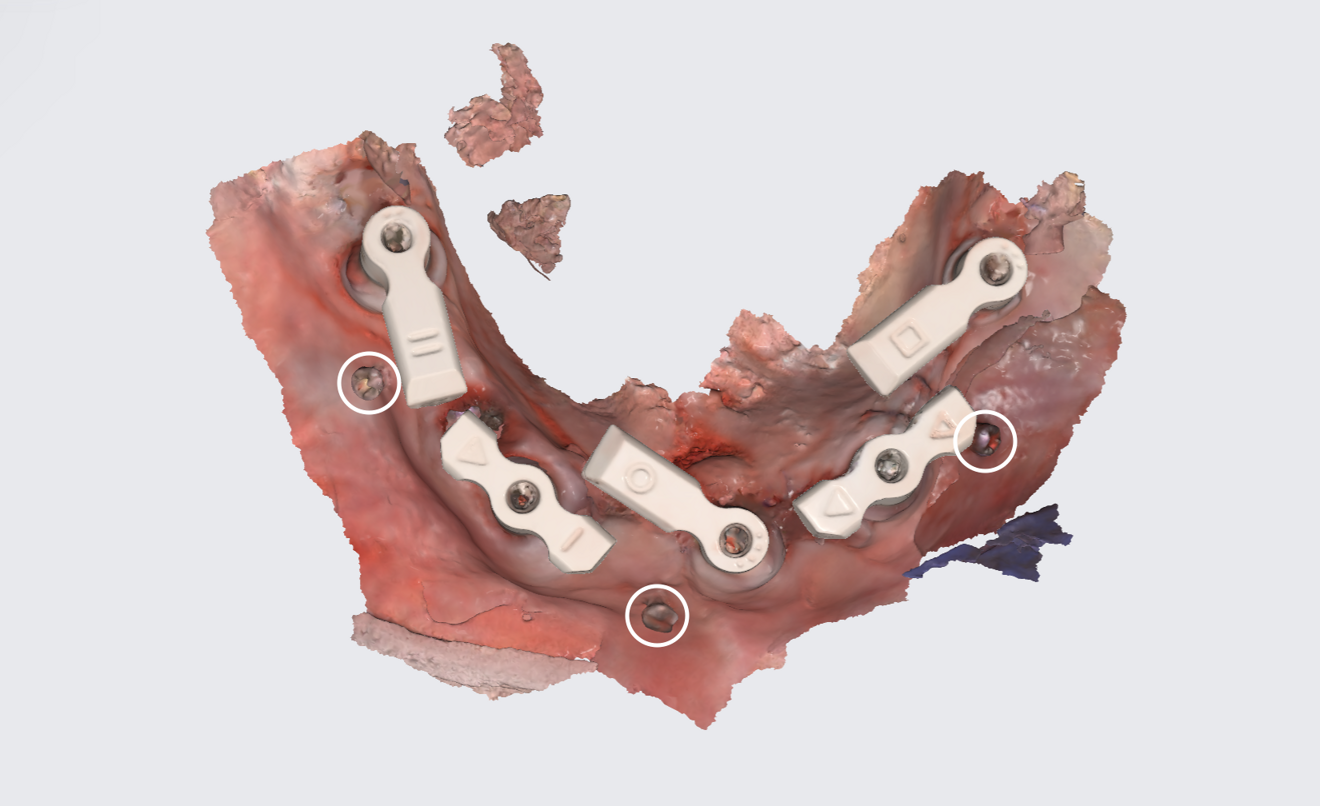 Fig. 6: Post-op scan with SmartFlags and osteosynthesis screws (circled).