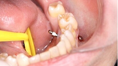 Intrusión de sectores posteriores con microimplantes