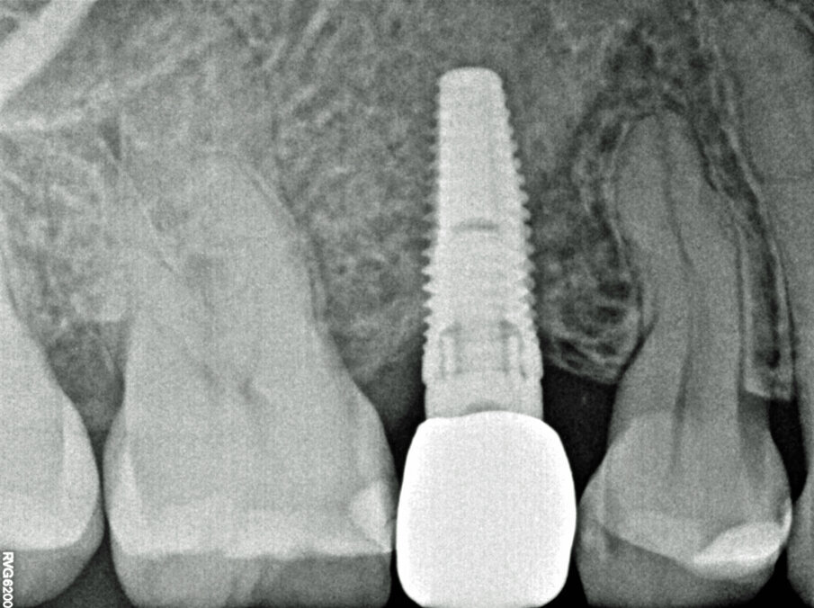 Fig. 30 - Controllo radiografico a 6 anni.