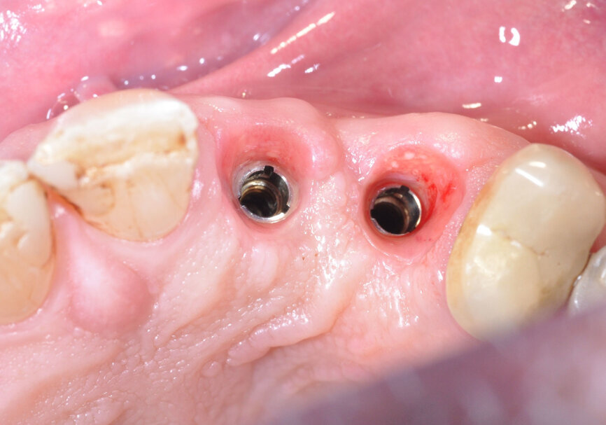 Ideal shaping and thickening of the soft tissue in height and width. (Image: Inga Boehncke)