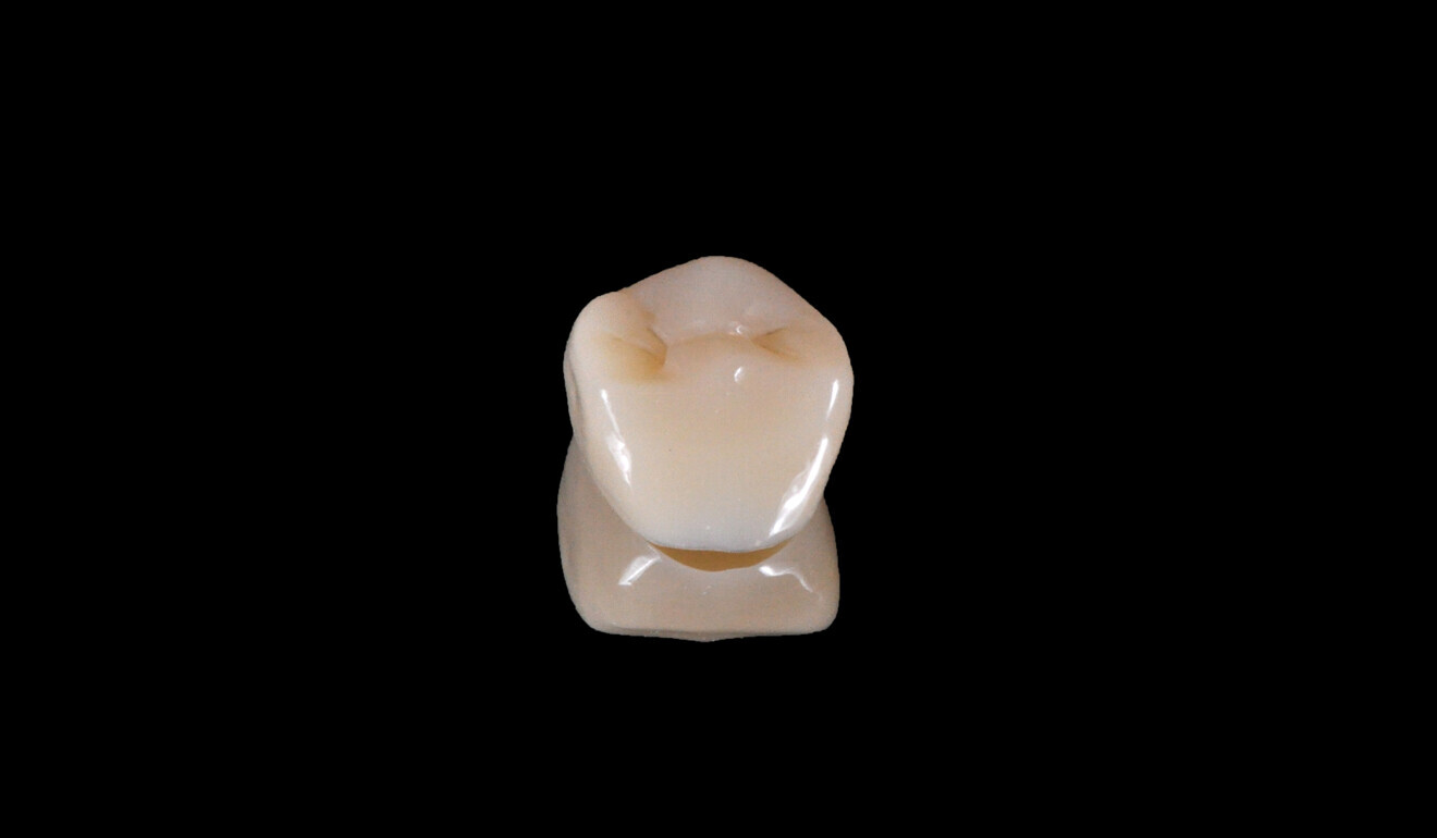 Fig. 12: Hybrid ceramic overlay. 