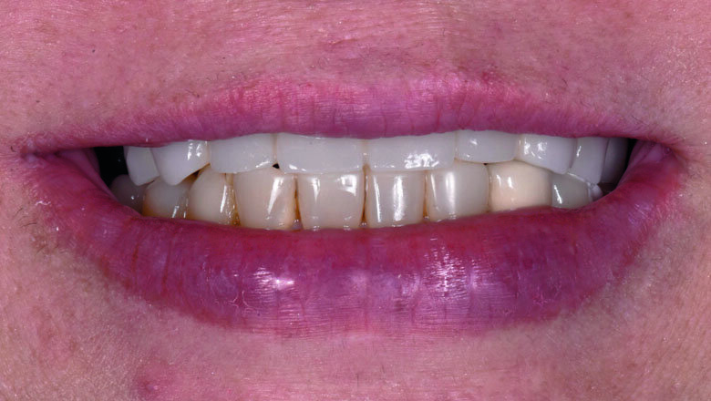Fig 4. Extraoral smile with FDP in place