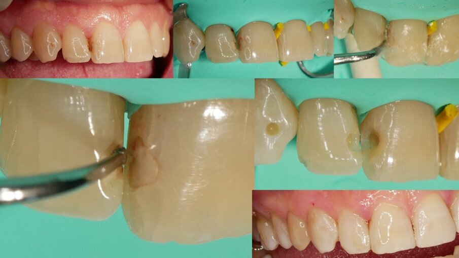 Fig. 11 - Inserti da micro preparazione con parte lavorante selettiva mesiale o distale. Sono apprezzabili la precisione e l’uniformità della preparazione.