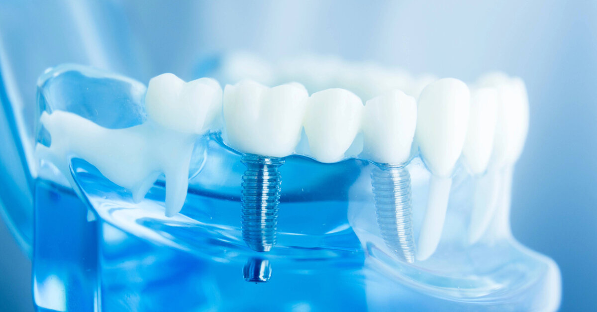3DDX launches AI Planning for implant cases