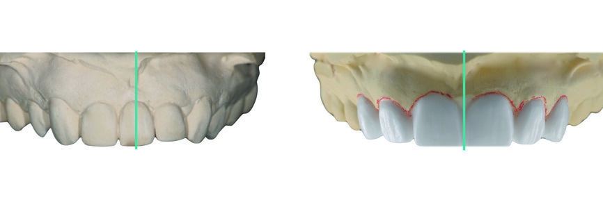 Fig. 6 : Wax-up, vue de face.