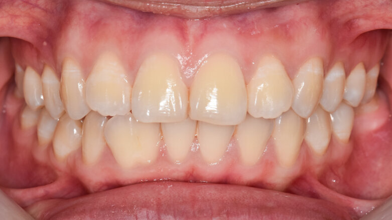 Researchers uncover how oral bacteria can affect the aggressiveness of colon cancers
