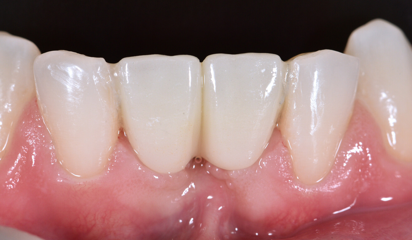Fig. 9: Clinical situation immediately after cementation.
