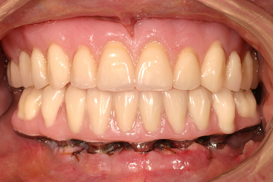 Fig. 6. Prótesis Híbrida inmediata y radiografía control con 6 años post-operatorio