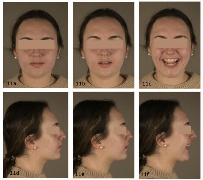 Figs. 11a–f: Post-treatment extra-oral photographs.
