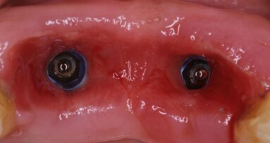 Rise of minimally invasive techniques for soft tissue augmentation – A tale of promise and pitfalls