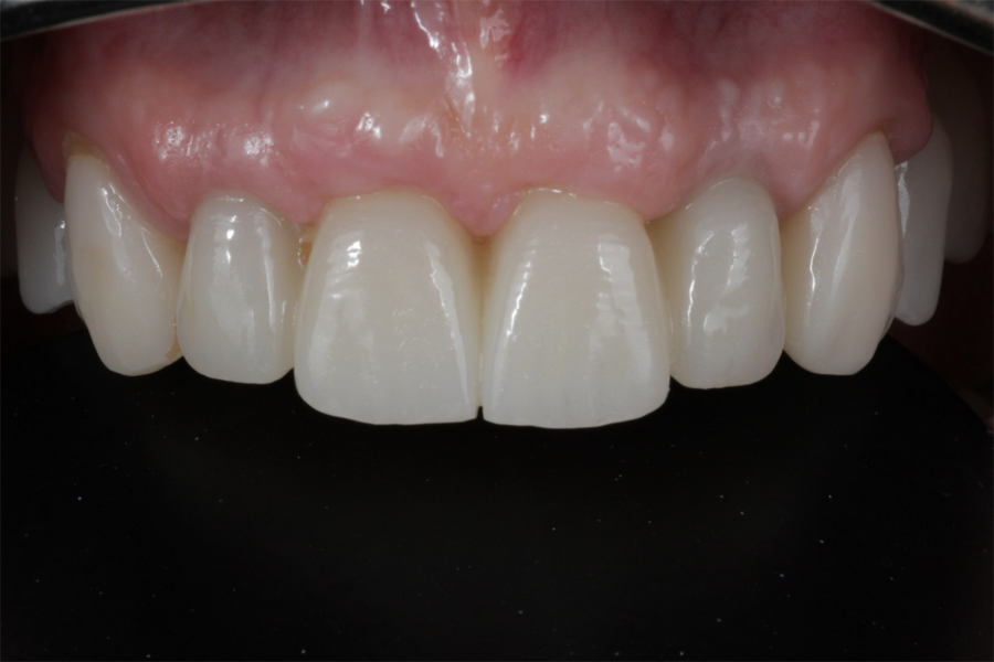 Fig. 14: Frontal aspect of the definitive prosthetic restorations, showing good aesthetic conditions with no signs of soft-tissue complications after insertion.