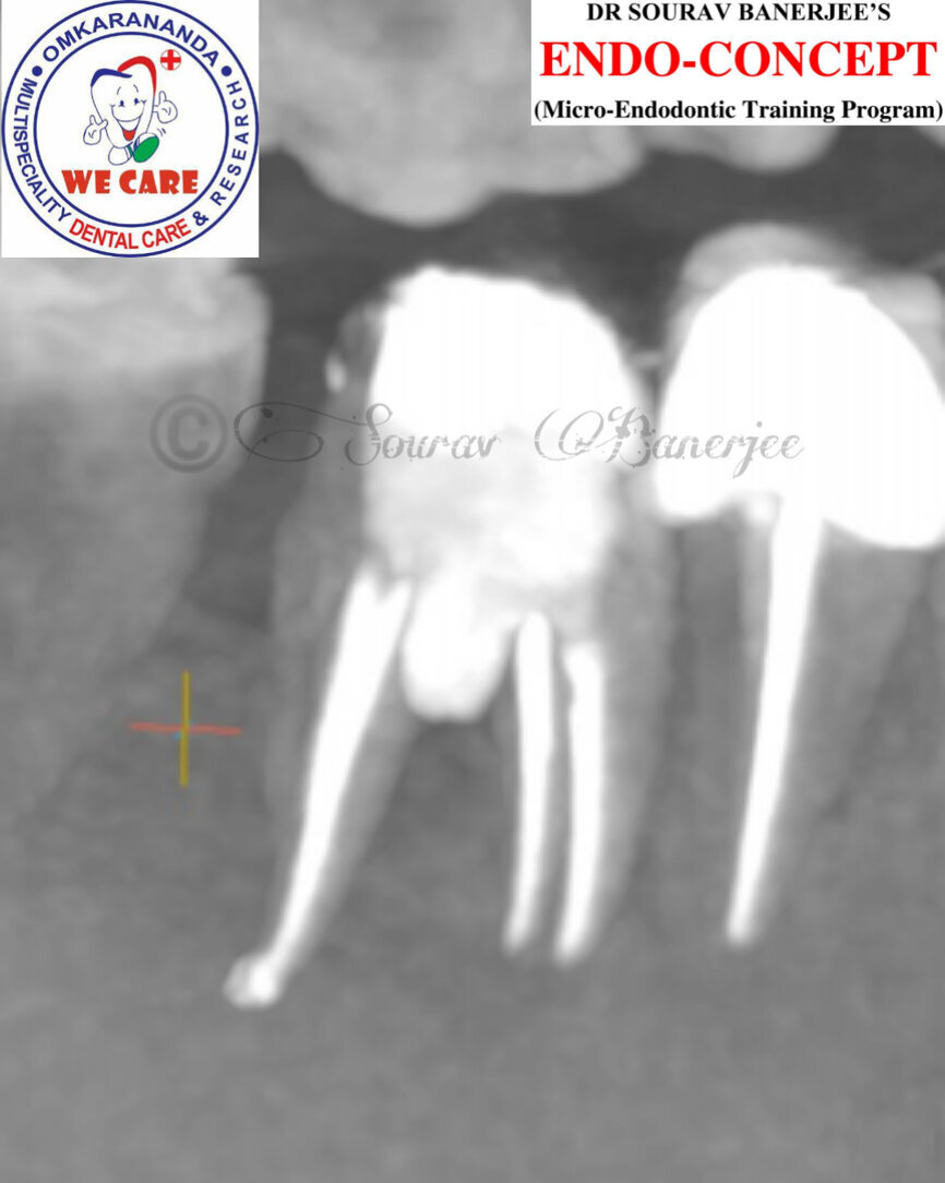 Fig. 6g: Post-op CBCT images of tooth #46 showing adequately obturated canals at all levels to the working length and sealing of the furcation defect.