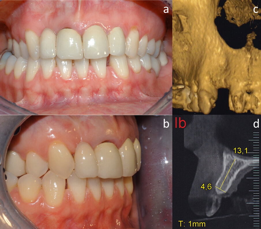 Fig. 1 - Aspetto clinico (a, b) e radiografico (c, d) della paziente prima dell’intervento.