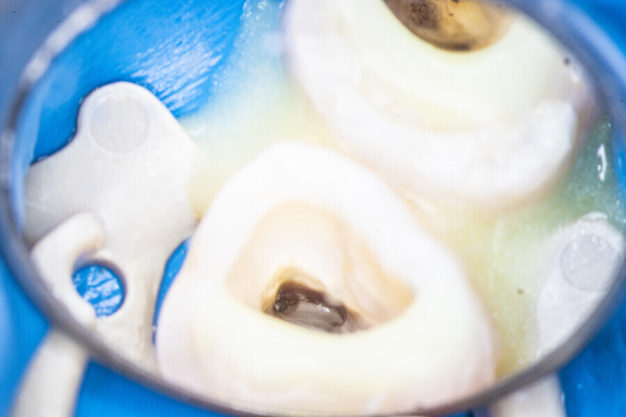 Fig. 16: The MB1 canal and isthmus. Stage of locating the MB2 orifice in the second molar. No patency was reached.