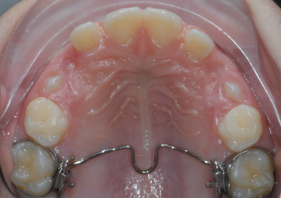 Fig. 9_Estrazione 5.3-6.3.