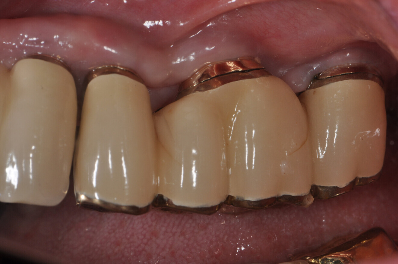 Stabilised gingiva two weeks after periodontal treatment around the implant.