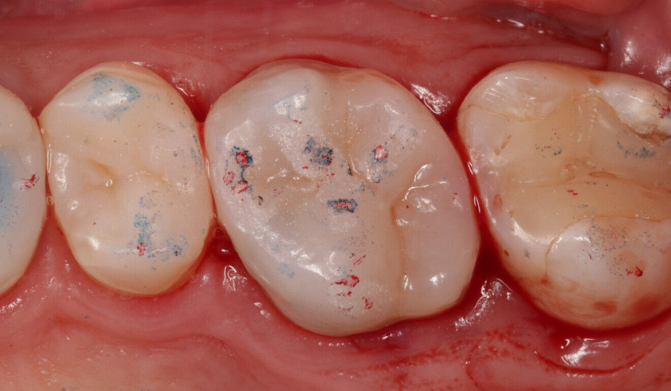Fig. 19: Occlusal adjustment. Contact points recorded with articulating paper (100 μm) and articulating foil (16 μm). (Image: Kuraray Noritake Dental)