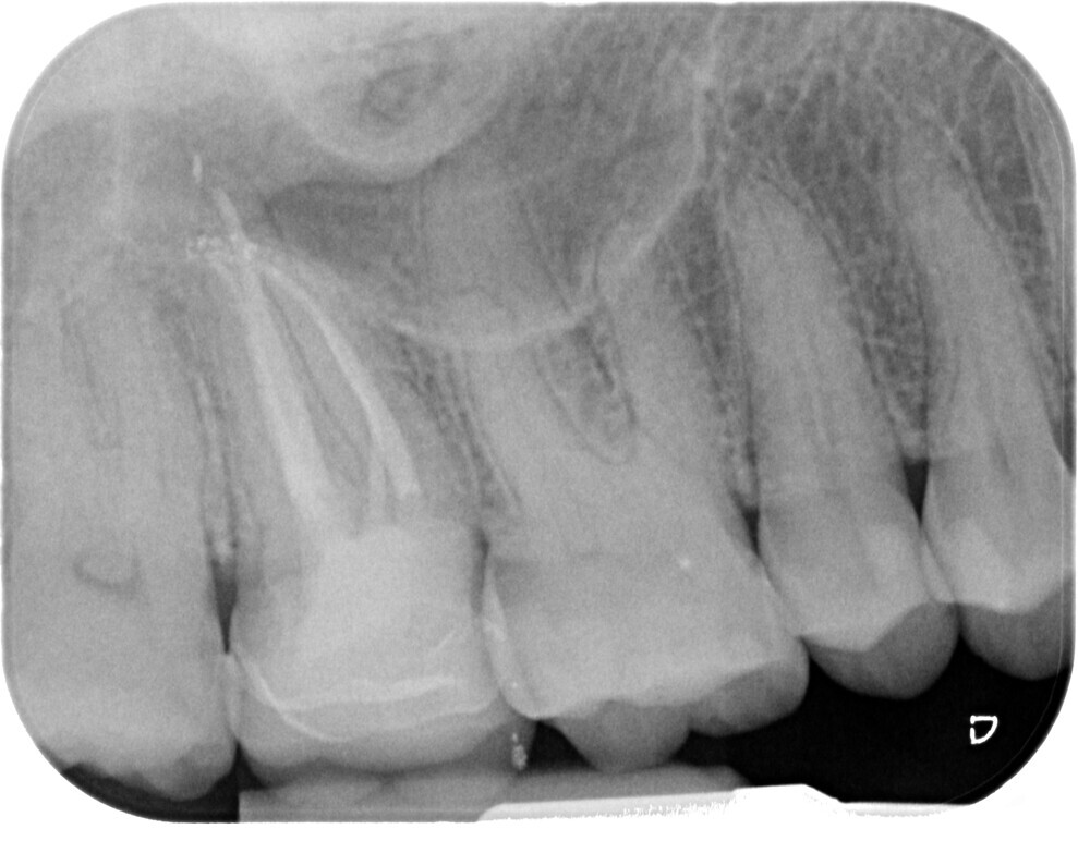 Fig. 5: One-year follow-up radiograph.