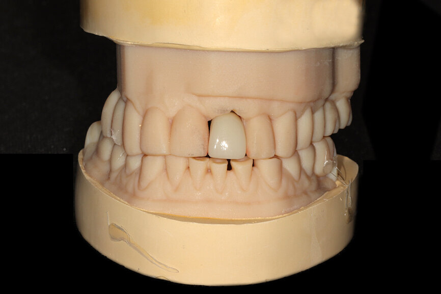 Fig. 16b: The accuracy of the implant and template design allows for true restoratively driven planning combined with CAD/CAM applications for the design
and fabrication of a patient-specific abutment and transitional restoration.
