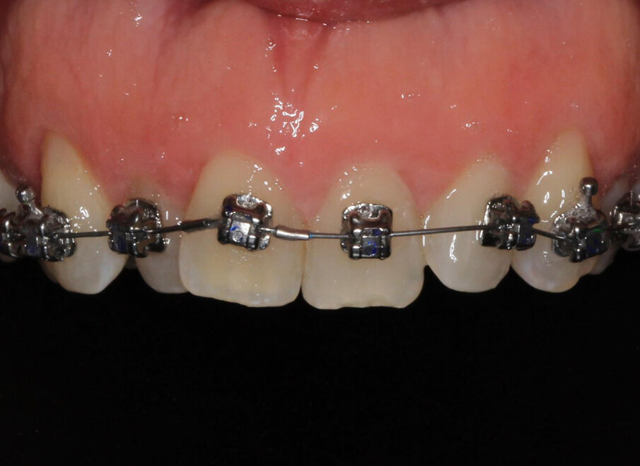 Initial treatment