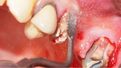 Gli strumenti sonici in odontostomatologia