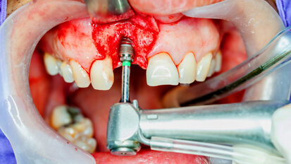 National standards for implant dentistry announced