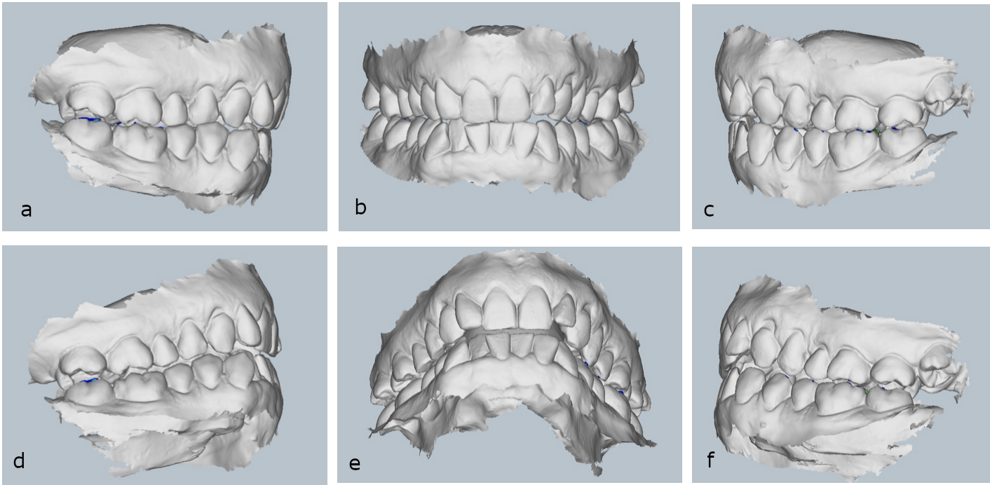 Figs. 36a–f: Pretreatment virtual mounting.