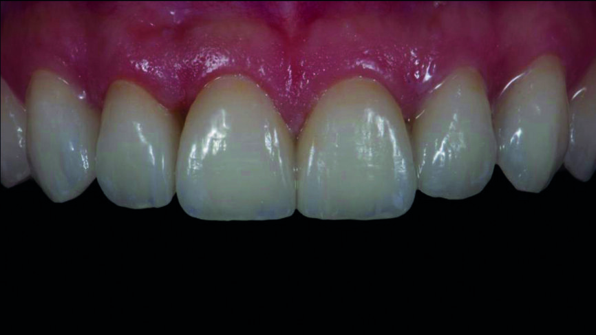 Fig. 15b : Facettes réalisées en technique CFAO avec pâte d‘essai. 