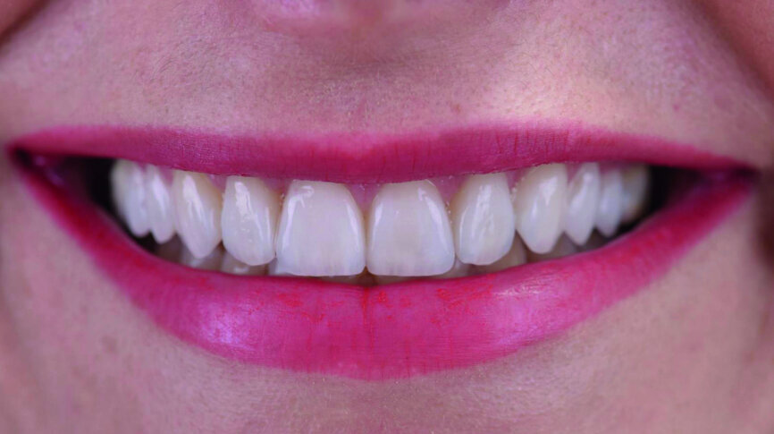 Fig. 17d: Wide smile.