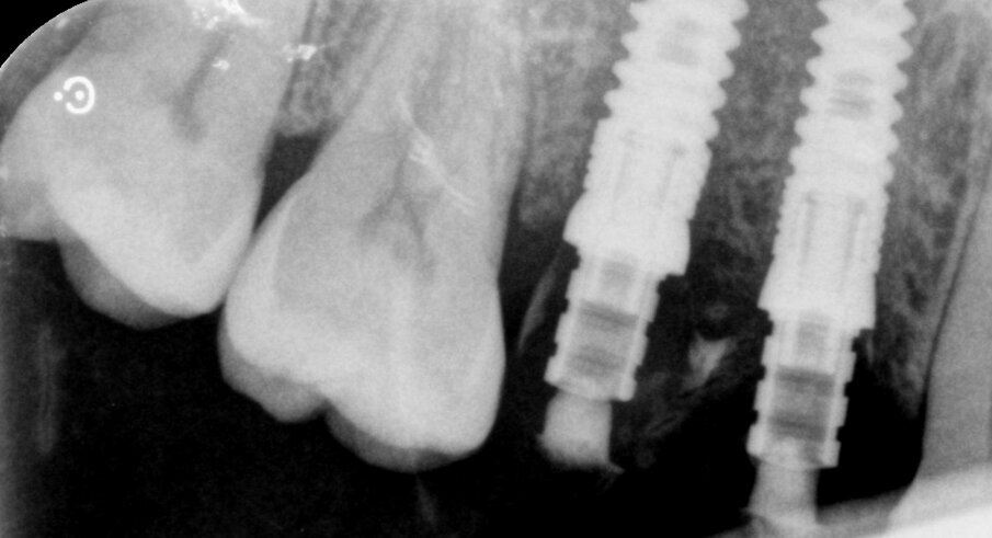 Fig. 7_Rx post-operatoria.