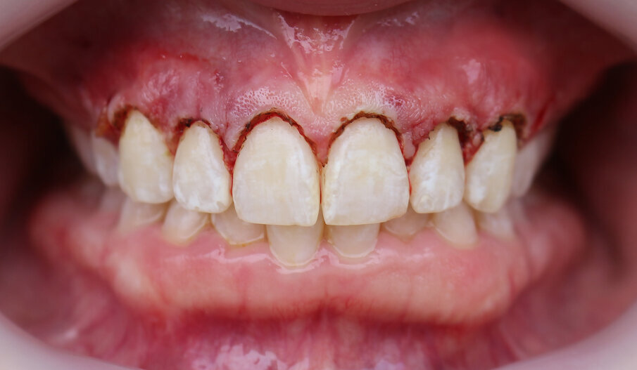 Fig. 3: Photograph taken immediately after the exostosis removal, crown lengthening and laser contouring.
