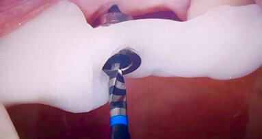 Guías Quirúrgicas Preformadas para implantología, ortodoncia y endodoncia