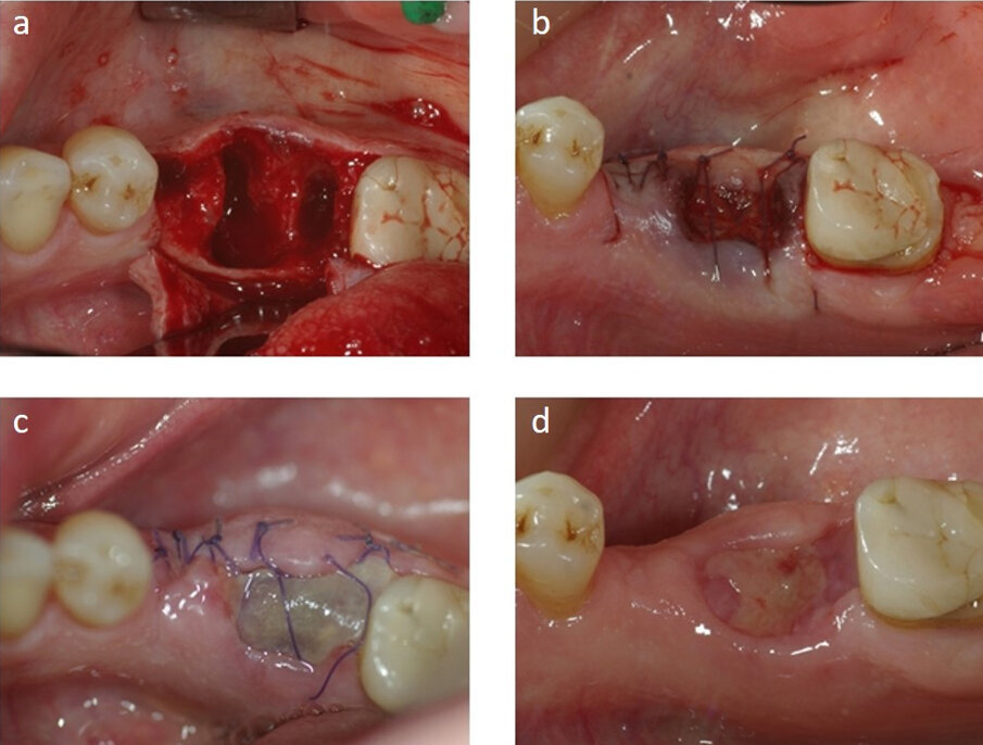 Fig. 3 - a: l’alveolo post-estrattivo prima dell’applicazione della tecnica di ridge preservation. b: l’alveolo viene riempito con il sostituto osseo equino e protetto con una membrana in pericardio in doppio strato, lasciata esposta. c: aspetto clinico a 7 giorni. Il processo di guarigione della mucosa è in corso e non si rilevano segni di infiammazione o infezione. d: a 21 giorni si osserva la presenza di tessuto di granulazione e la guarigione è in fase avanzata.