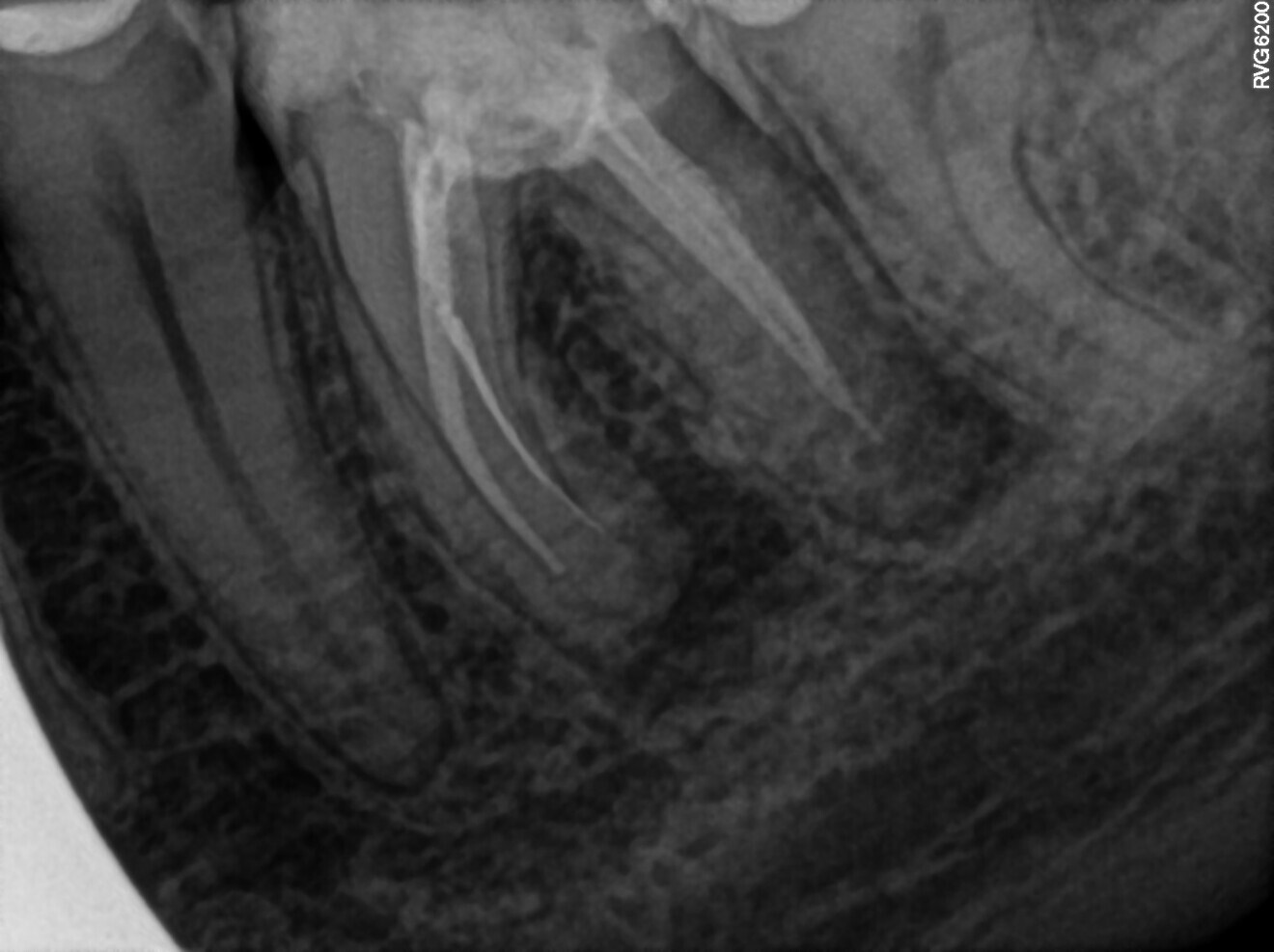 Fig. 27: Pre-op radiograph. Broken files visible.