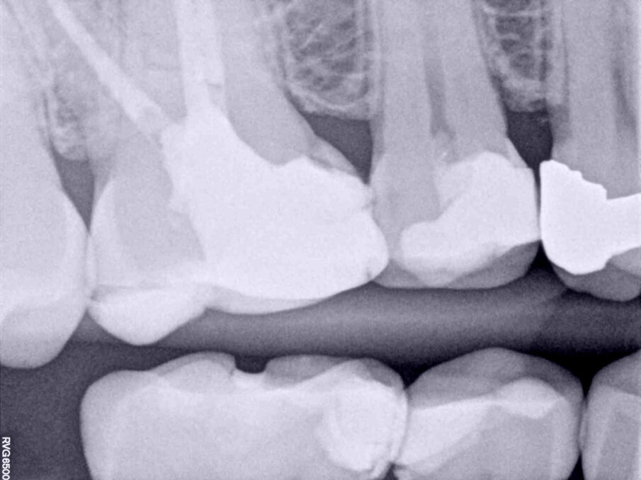 Fig. 3: Three-year follow-up radiograph showing the well-adapted restoration.