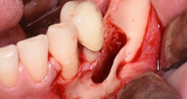 Chirurgia piezoelettrica dei denti inclusi: case report