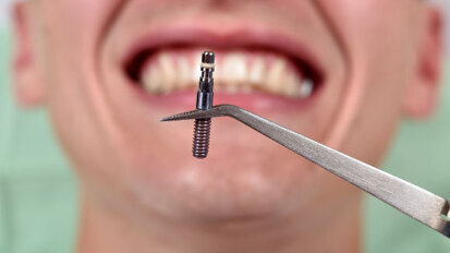 Los errores de los pacientes sobre los implantes dentales