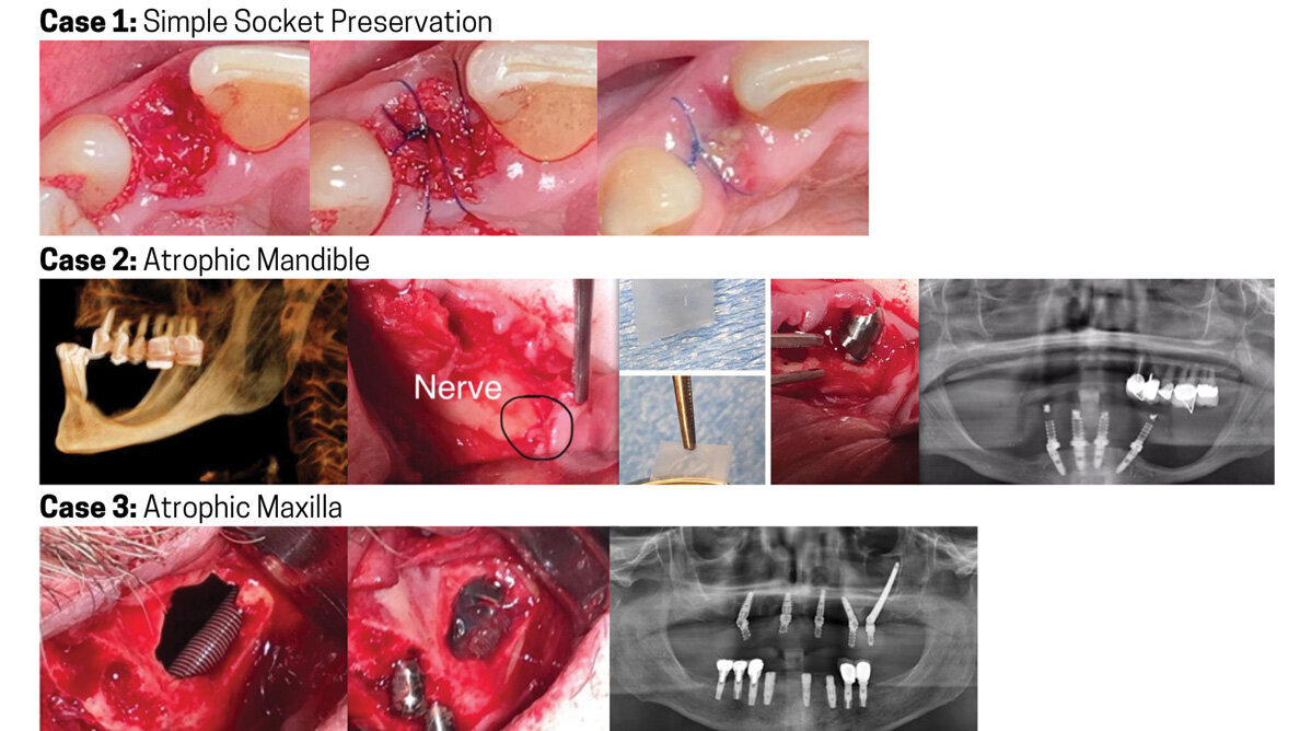 The most versatile barrier membrane for oral/maxillofacial applications