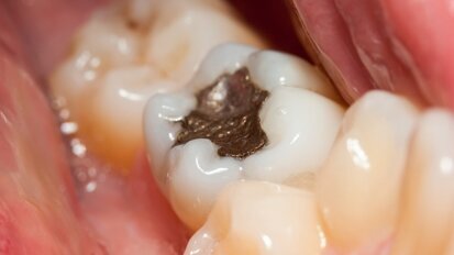A redução de amálgamas dentárias endossada pela UE entra em vigor