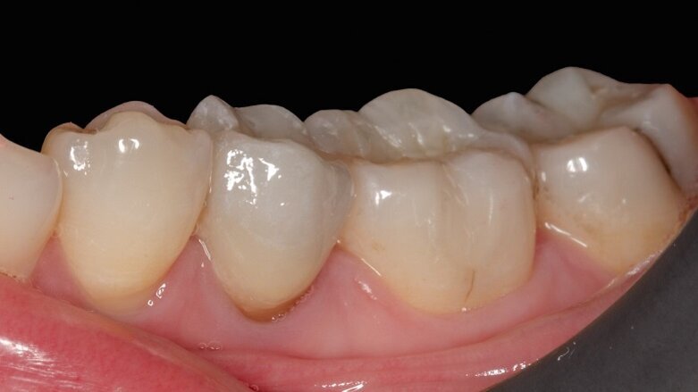 Daily aesthetic dentistry: The contribution of the spectrophotometer