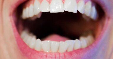 Botox A for OSMF: a novel therapeutic approach