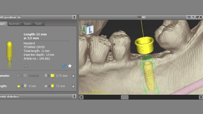 Dental Wings integra implantes da Neodent em software de cirurgia guiada