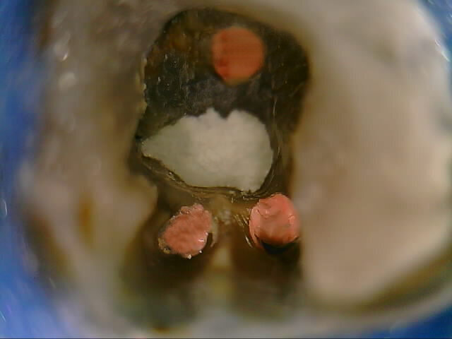 Figs. 4: Clinical and radiographic appearance of drilling filling with MTA Repair HP.