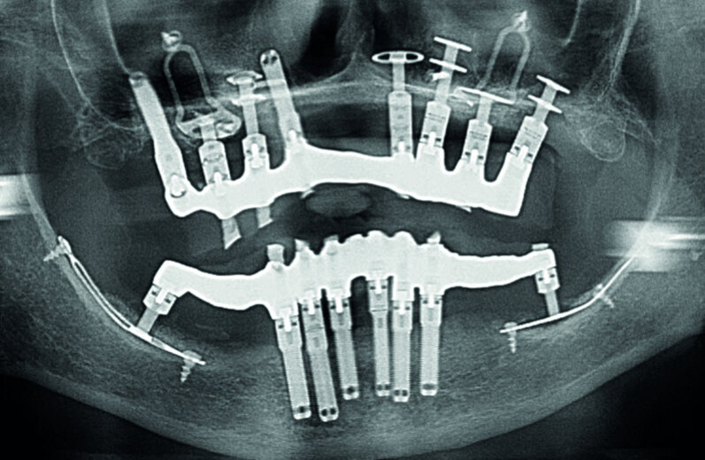 Figs. 8a et b : Contrôles radiologiques du bon ajustement des armatures après vissage. 