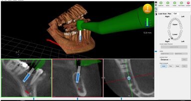 Neocis reaches first commercial milestone for Yomi surgical system
