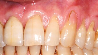 El 72% de los adultos mayores presenta recesión gingival