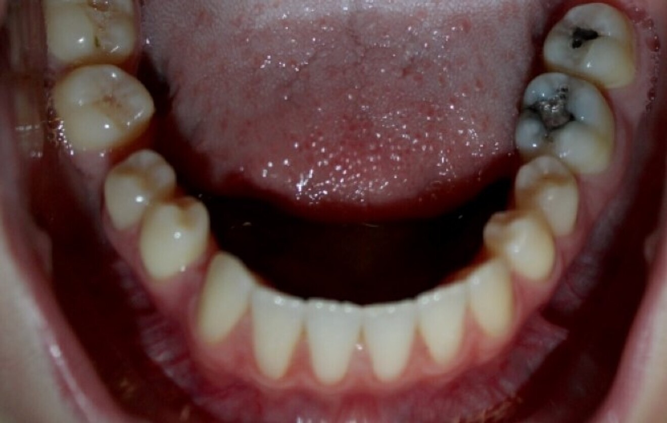 Fig. 20b: Class III malocclusion requiring fixed appliance treatment. (a) Frontal view. (b) Occlusal view.