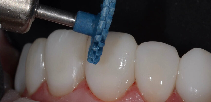 Fig. 13: To create a natural gloss, the following polishing protocol was used: (1) Sof-Lex discs (3M); (2) CLEARFIL Twist DIA for Composite polishing wheels; (3) diamond paste; and (4) zinc oxide paste. 