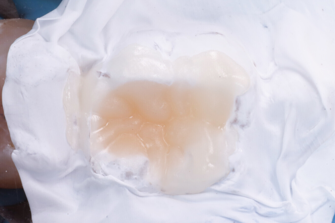 Fig. 19: Composite after removal of the silicone index.