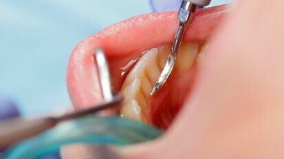 Study offers new insights into dental caries development and prevention